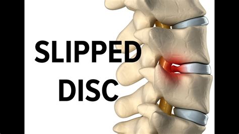 slipped disc music